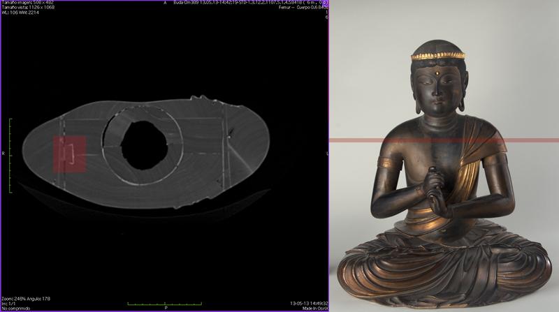 Tomografía computarizada hombros